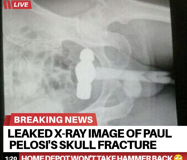 Click image for larger version. 

Name:	x-ray-image-of-paul-pelosis-skull-fracture.jpg 
Views:	1250 
Size:	74.1 KB 
ID:	21447